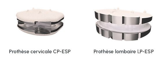 Prothèses ESP
